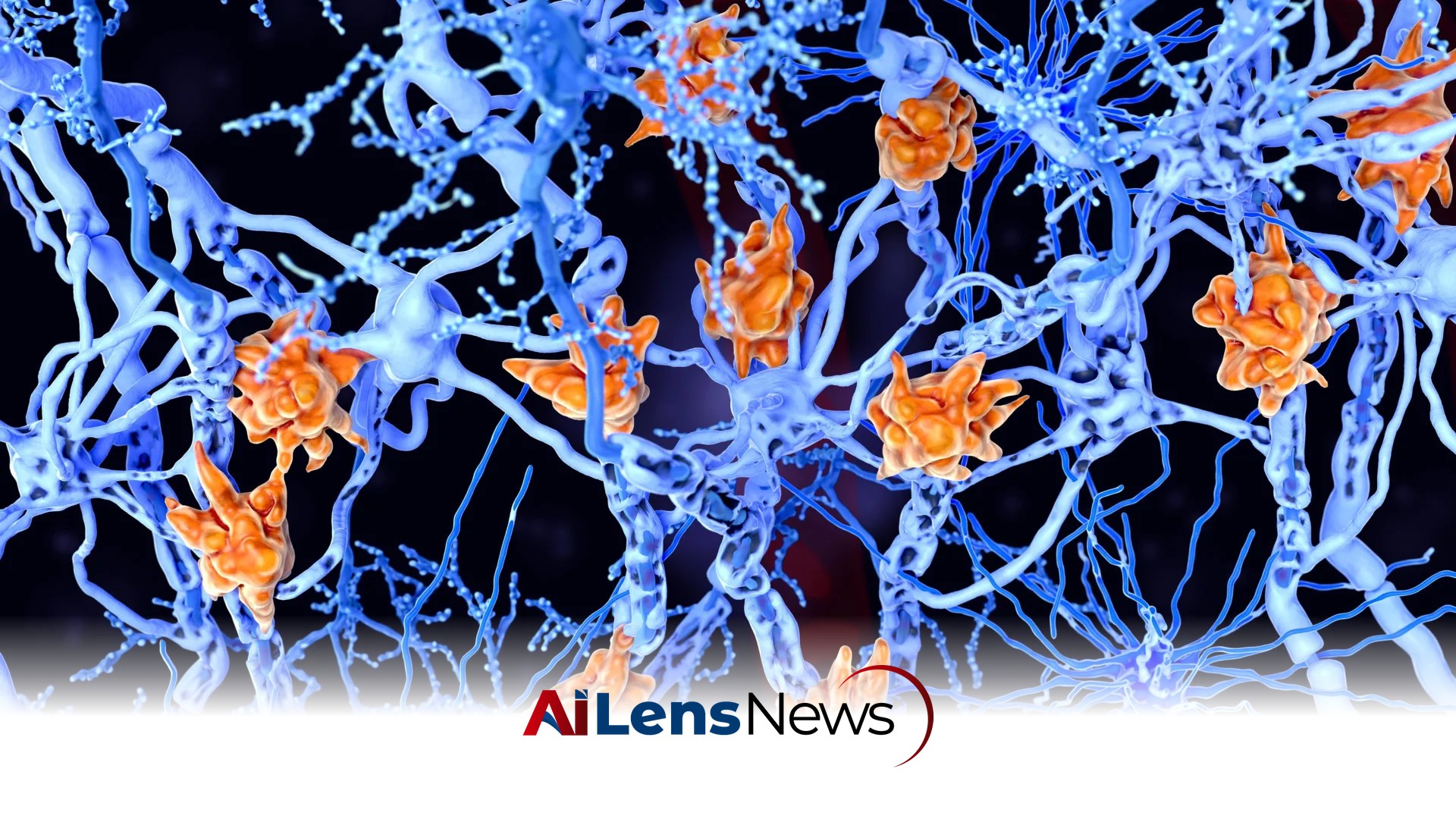 These fat-filled brain cells may be making multiple sclerosis worse